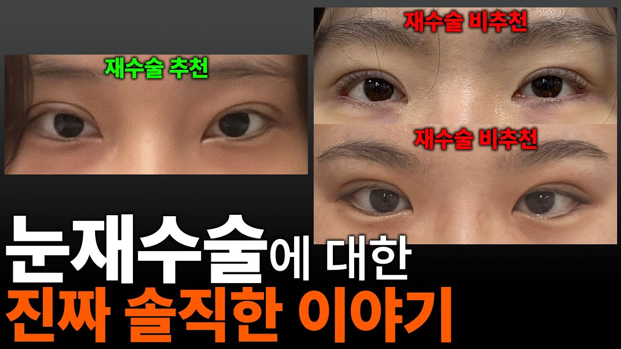 눈재수술 원장의 눈재수술에 대해 너무 현실적인 이야기