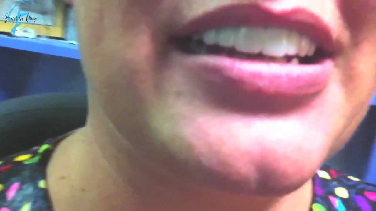 The MOST AMAZING Clear Choice Dental Alternative (Before and After)
