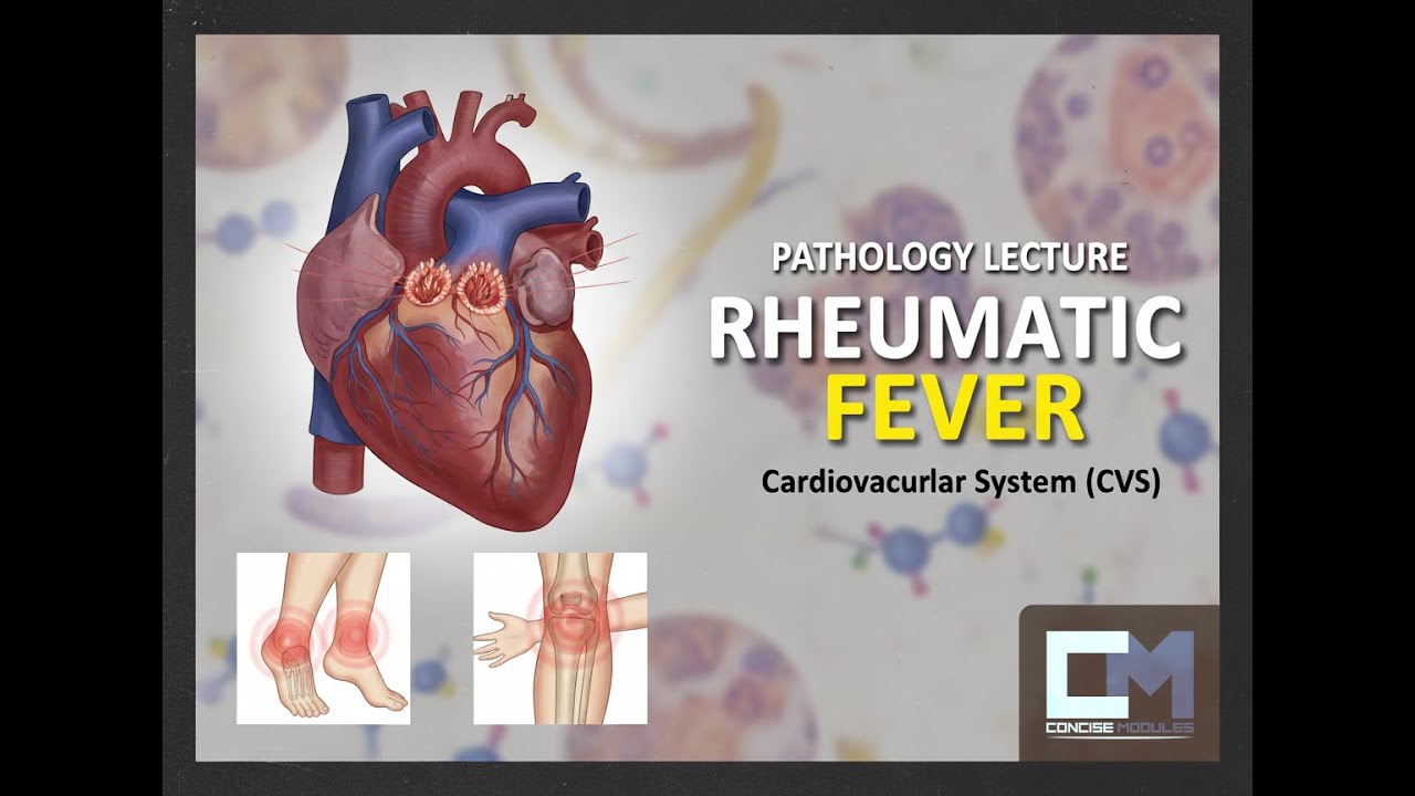 #Pathology #CVS - #Rheumatic fever (Part 1) | #Concise Modules