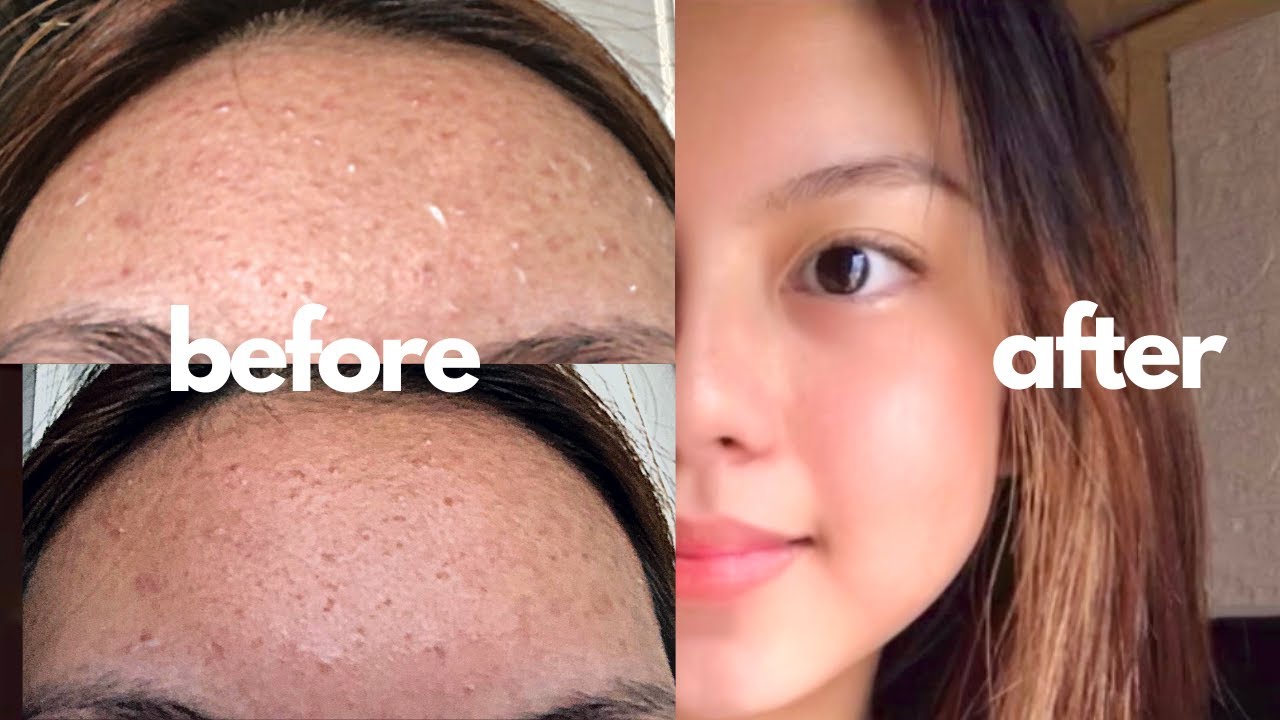 How I FINALLY Cleared My Skin ft. Tiny Bumps | Comedonal Acne | Philippines