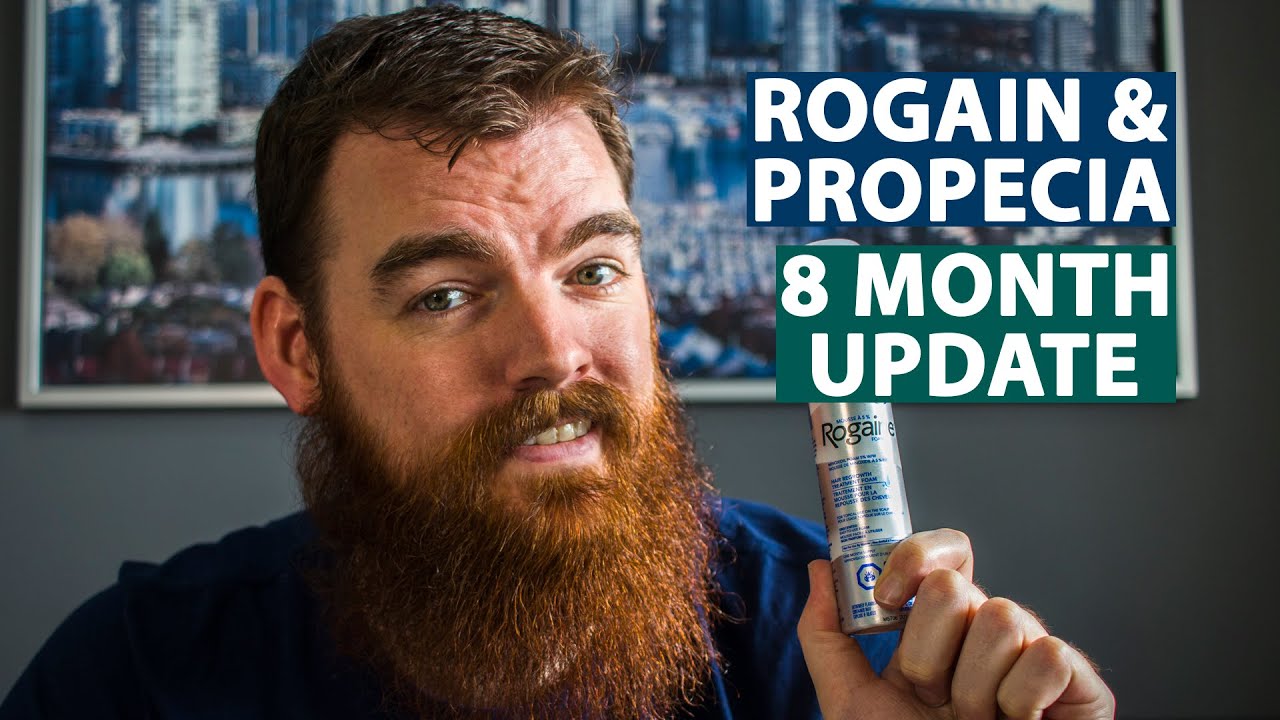 Minoxidil Results | 8 Months Using Rogaine & Propecia