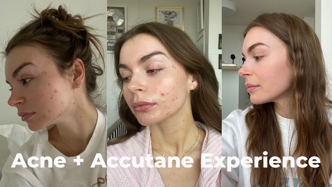 ACNE & EPURIS (ACCUTANE) EXPERIENCE | journey & side effects