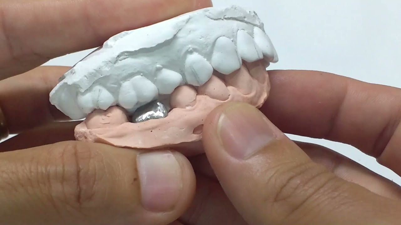 Aplicação de Coroa Metalo Cerâmica Passo a Passo - Curso de Prótese Dentária On-Line Grátis