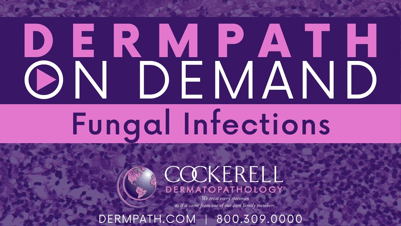 Fungal Infections