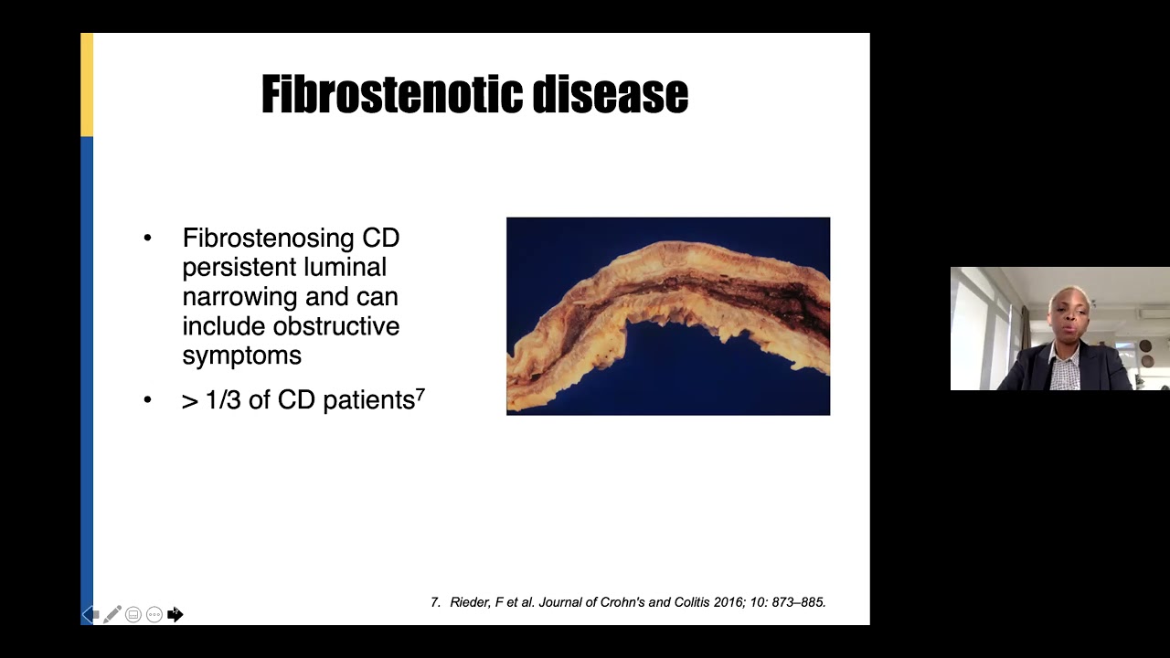 Inflammatory Bowel Disease:  Crohn