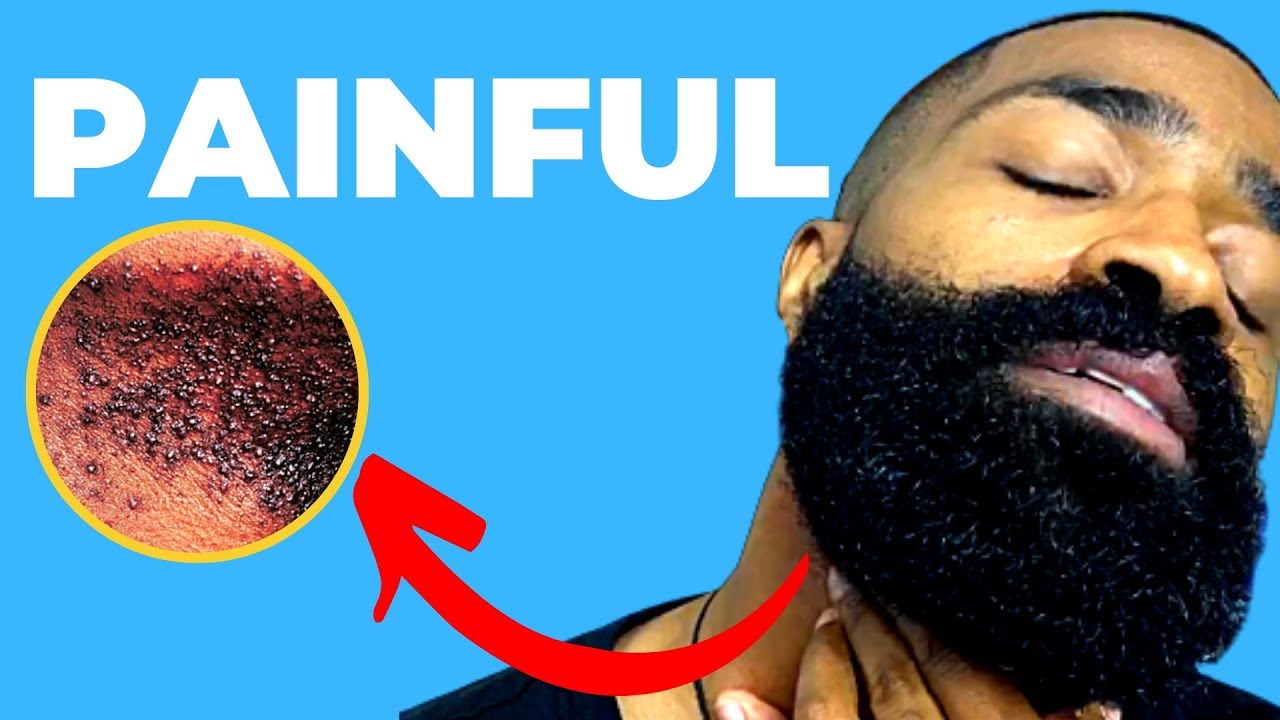 How To Dry Shave With NO BUMPS Under Beard