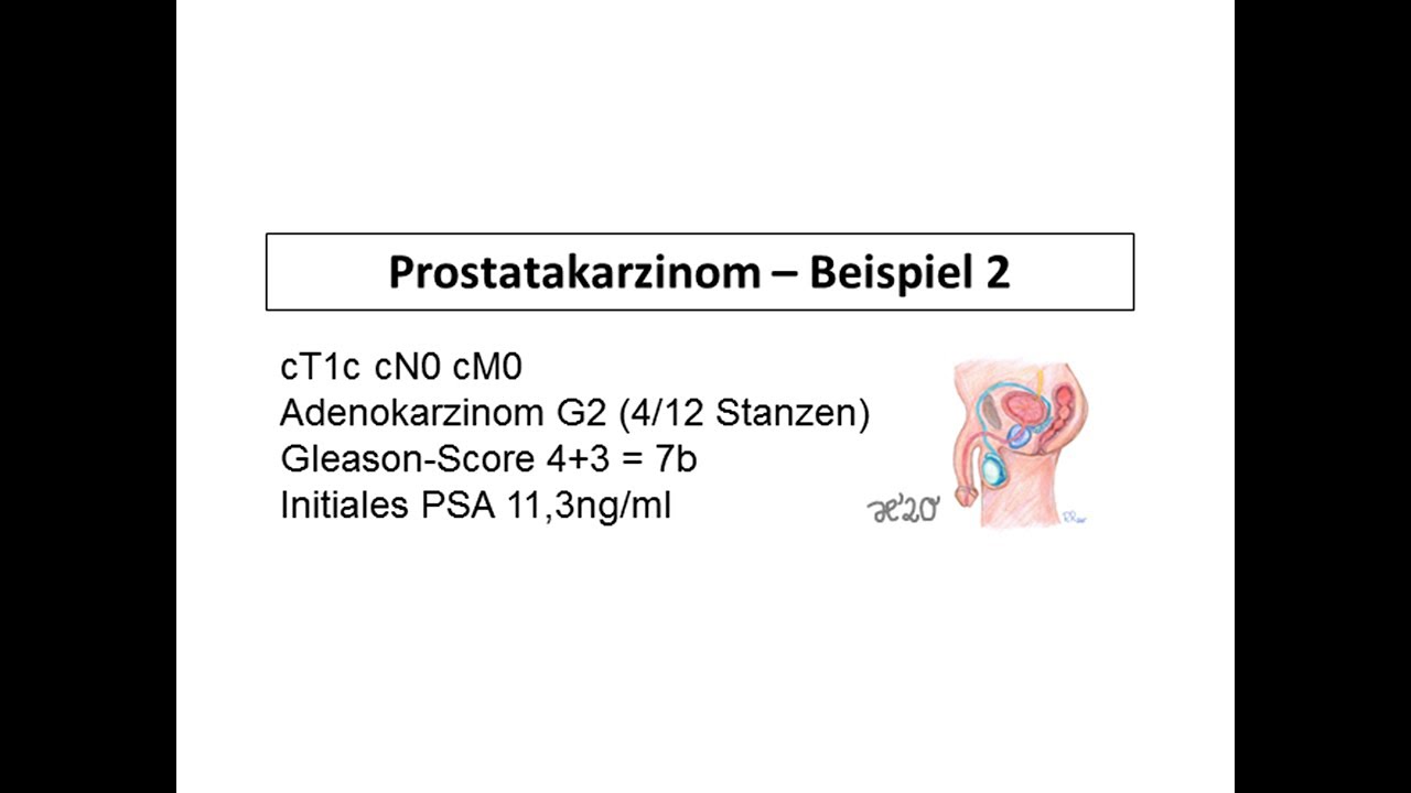 Beispiel 1 für die Behandlung eines Prostatakarzinoms | Strahlentherapie Prof. Hilke Vorwerk