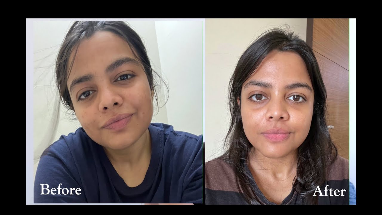 How I am improving my skin year after year | My ongoing skin transformation