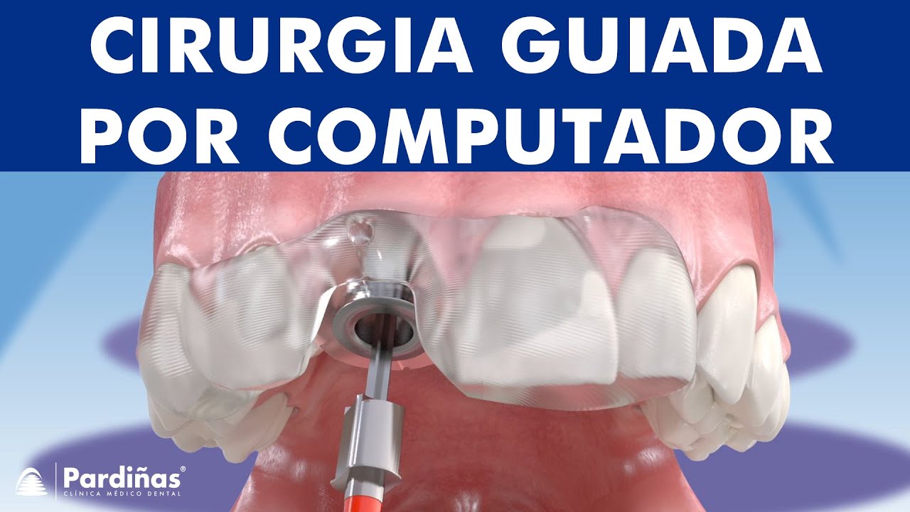 Cirurgia guiada por computador para a colocação de implante dentário ©