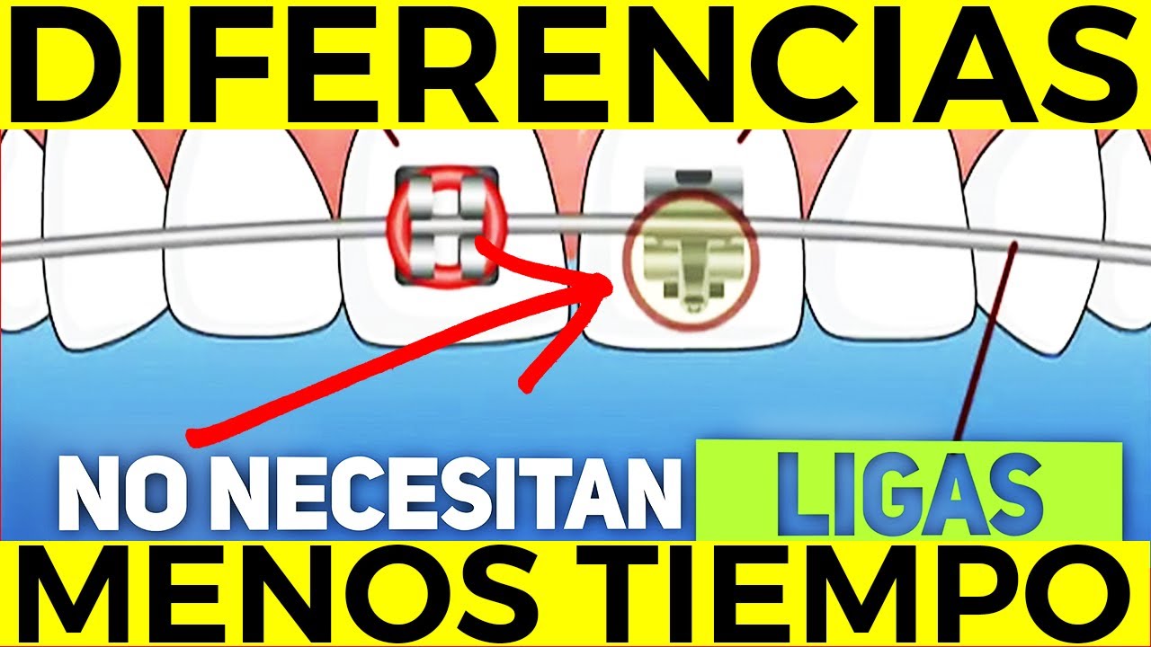 Tipo de BRACKETS para ENDEREZAR tus DIENTES CHUECOS más RÁPIDO | Conoce los Brackets Autoligables