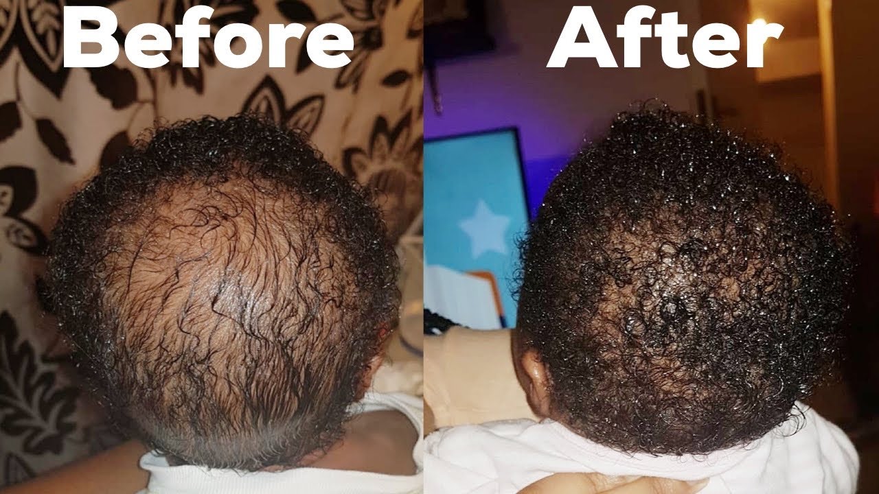 How to grow your baby bald hair fast using this natural remedies