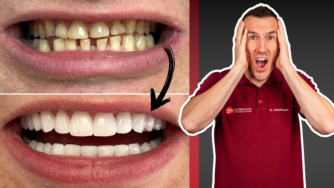 Krassester Fall des Jahres?! Hollywood Smile durch Komplett-Versorgung mit Zahnkronen & Brücken!