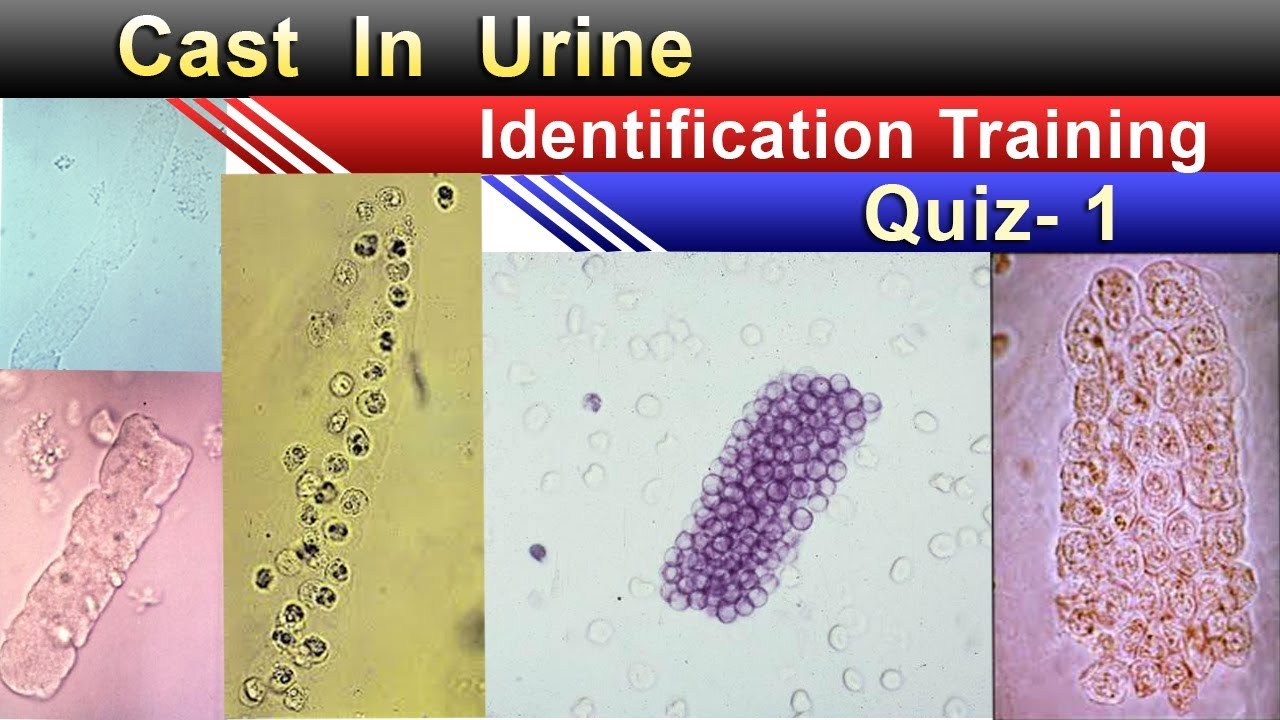 Urine Cast Identification Training Quiz -1