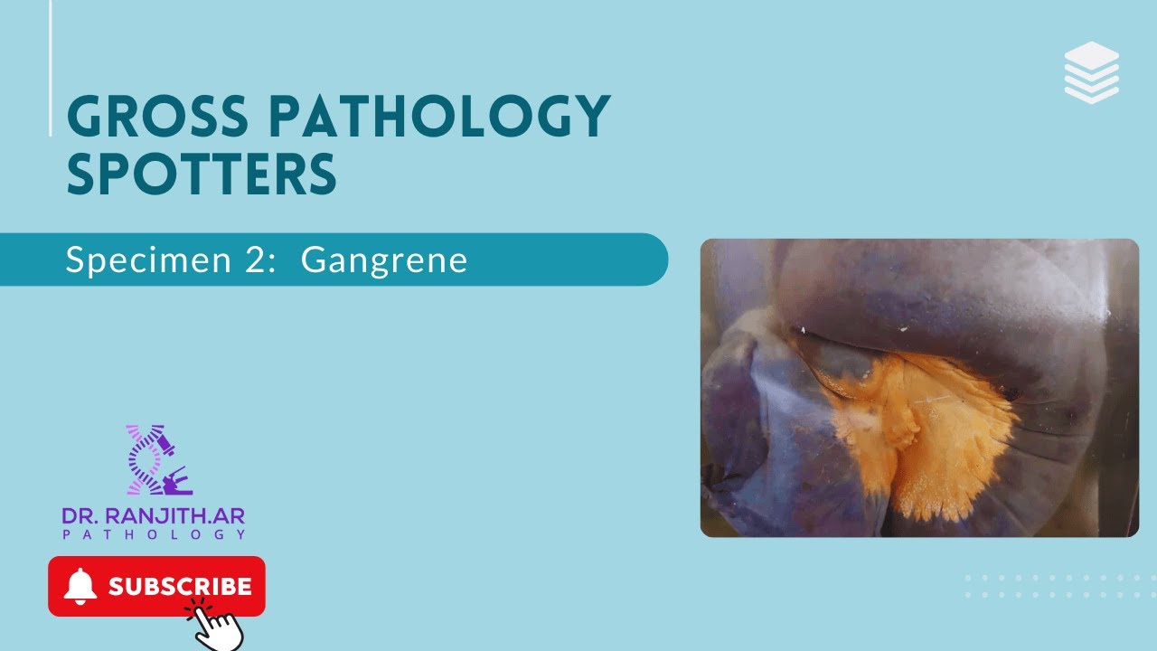 Gross Pathology spotters - Gangrene