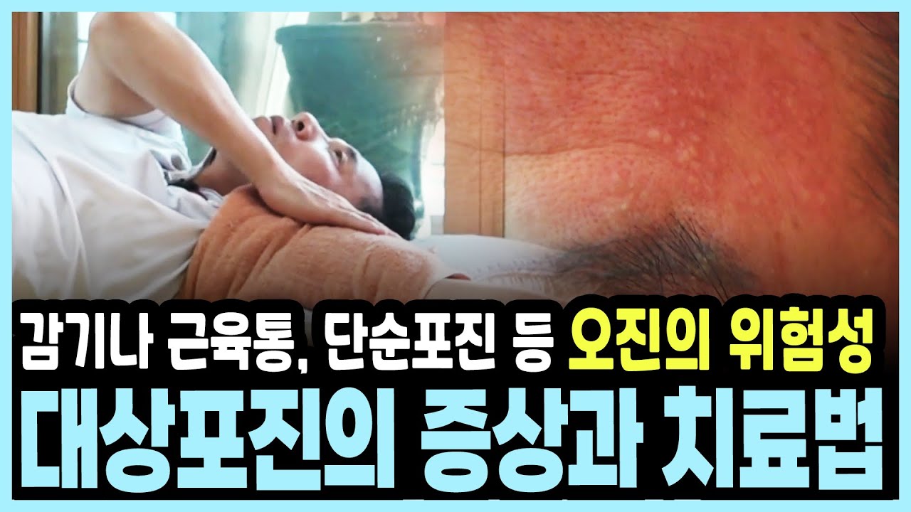 수포와 함께 찾아오는 지옥 같은 고통... 통증의 제왕 대상포진, 골든타임을 놓치면 평생 후회합니다 I KBS 20170806 방송