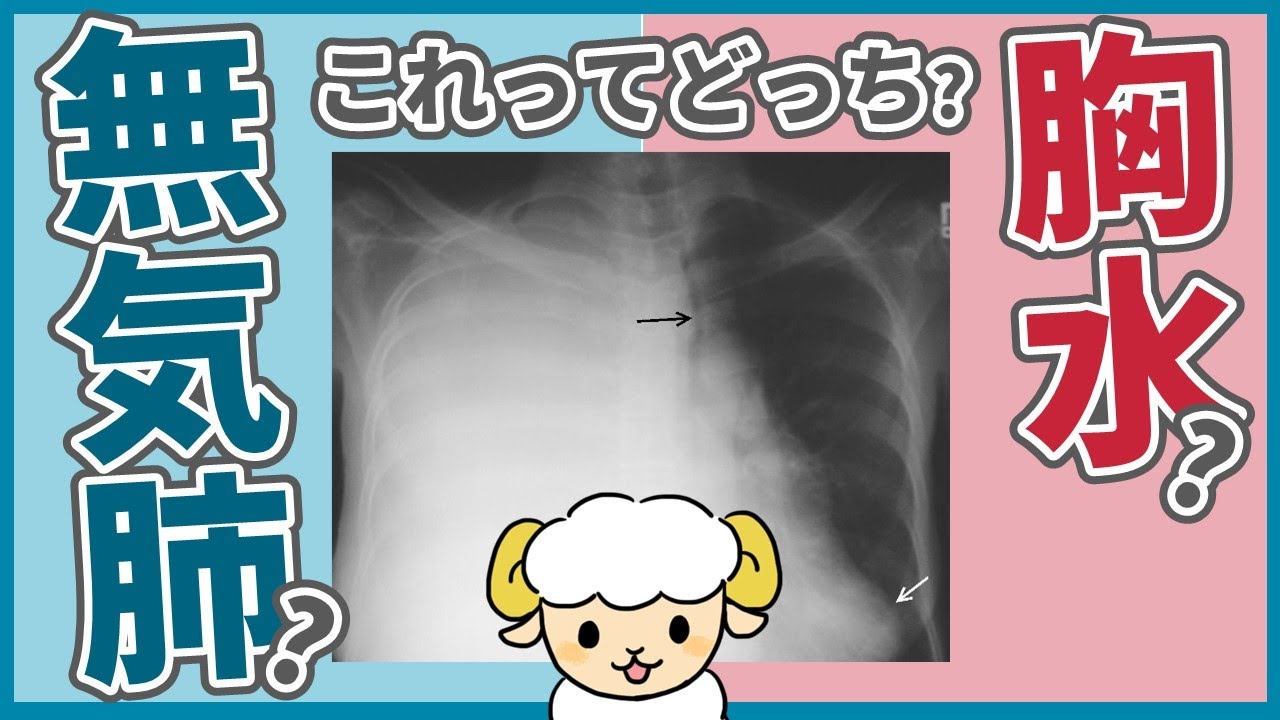 レントゲンで片方真っ白な時、無気肺と胸水の見分け方
