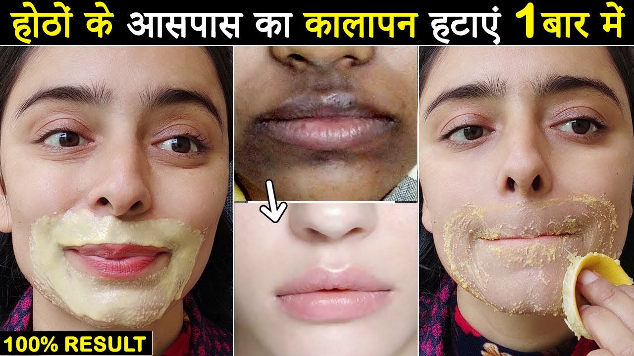 How to Remove Dark Black Patches, Dark Spots & Pigmentation Around Mouth | Remove Upper Lip Darkness