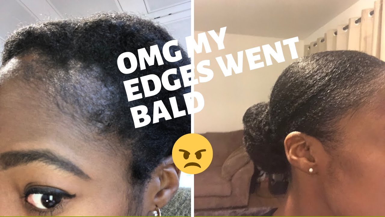 OMG MY EDGES WENT BALD