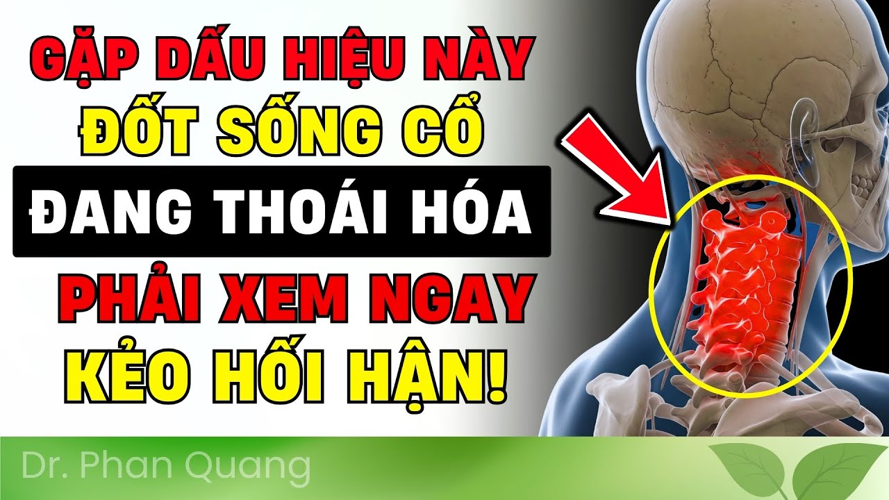 🔴 CẢNH BÁO! 7 Dấu Hiệu THOÁI HÓA CỘT SỐNG CỔ "SỚM" Ai Cũng Dễ Bỏ Qua (CẦN BIẾT NGAY!) Dr Phan Quang