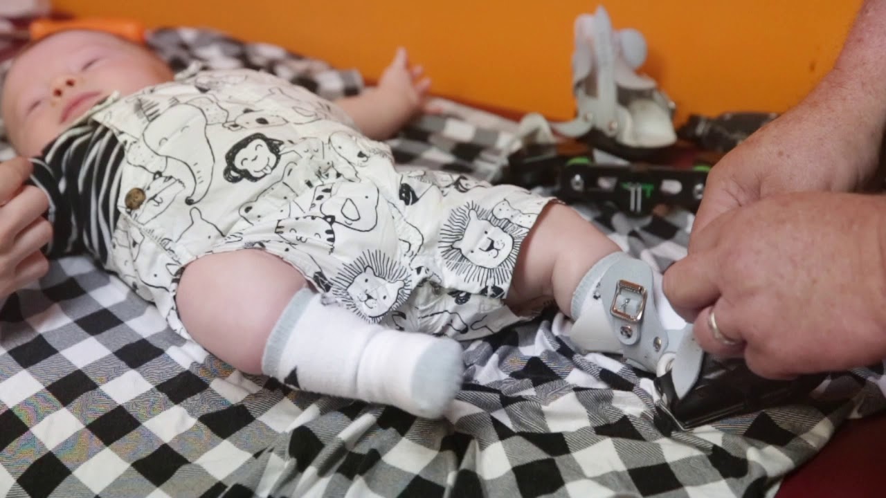 Dobbs Clubfoot Fitting Tutorial