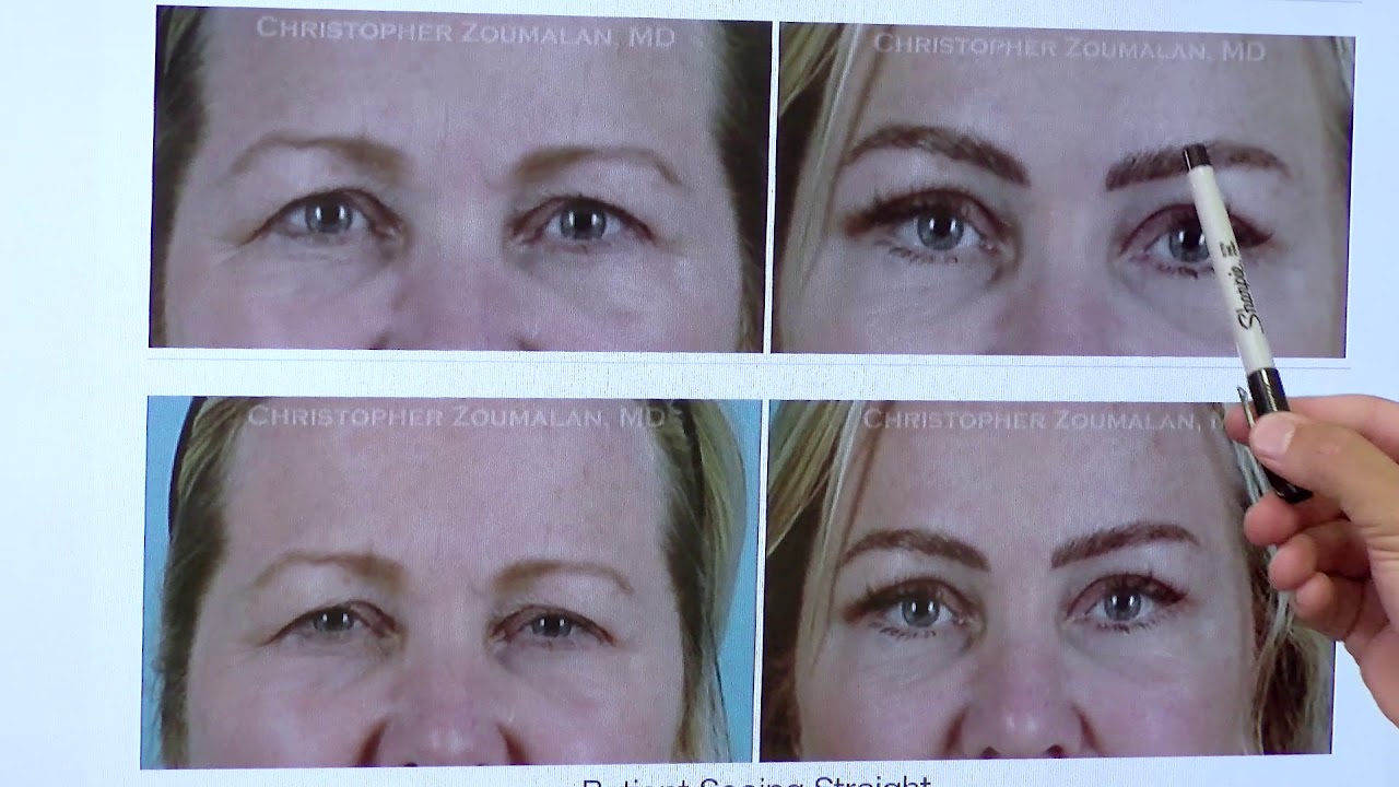Brow Lift Beverly Hills