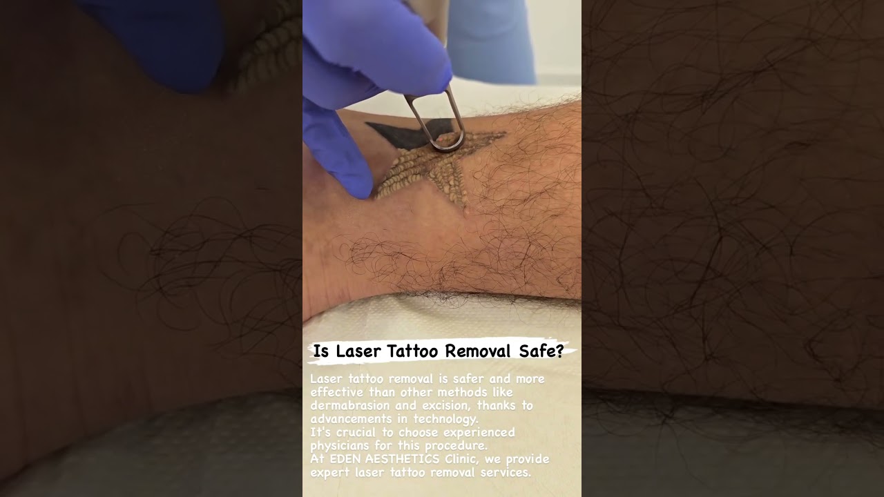 Laser Tattoo Removal in Dubai | Safe & Effective Treatment at EDEN Aesthetics Clinic