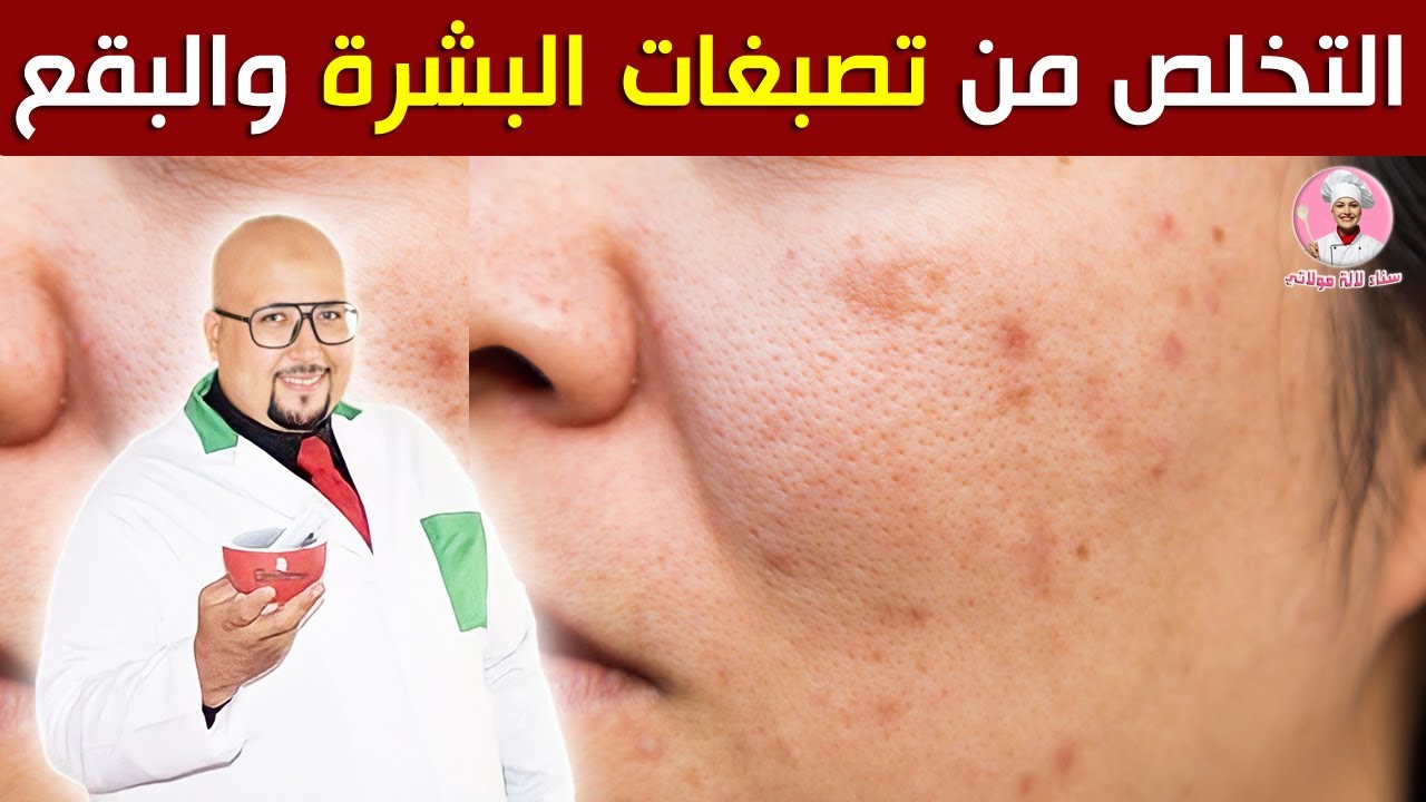 التخلص من تصبغات البشرة والبقع الداكنة مع الدكتور عماد ميزاب / Dr imad mizab