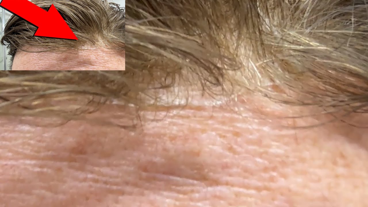 Plastic Hairline Problem