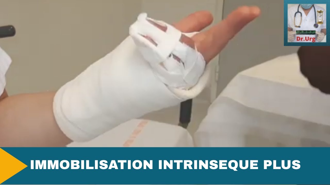 GANTELET METACARPIEN: Immobilisation intrinsèque plus