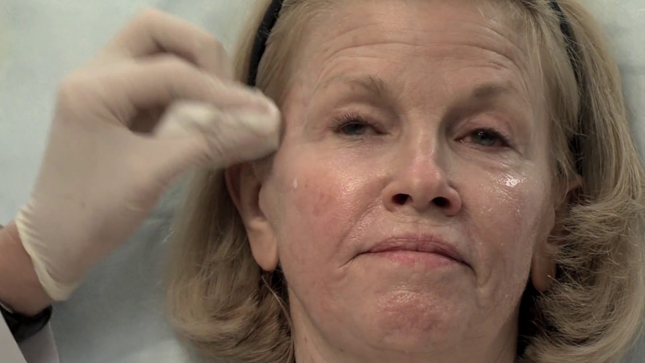 Voluma Filler for Cheek Enhancement - Dr. Lori Stetler
