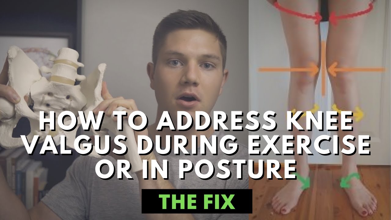 How to Address Knee Valgus During Exercise or In Posture - The Fix