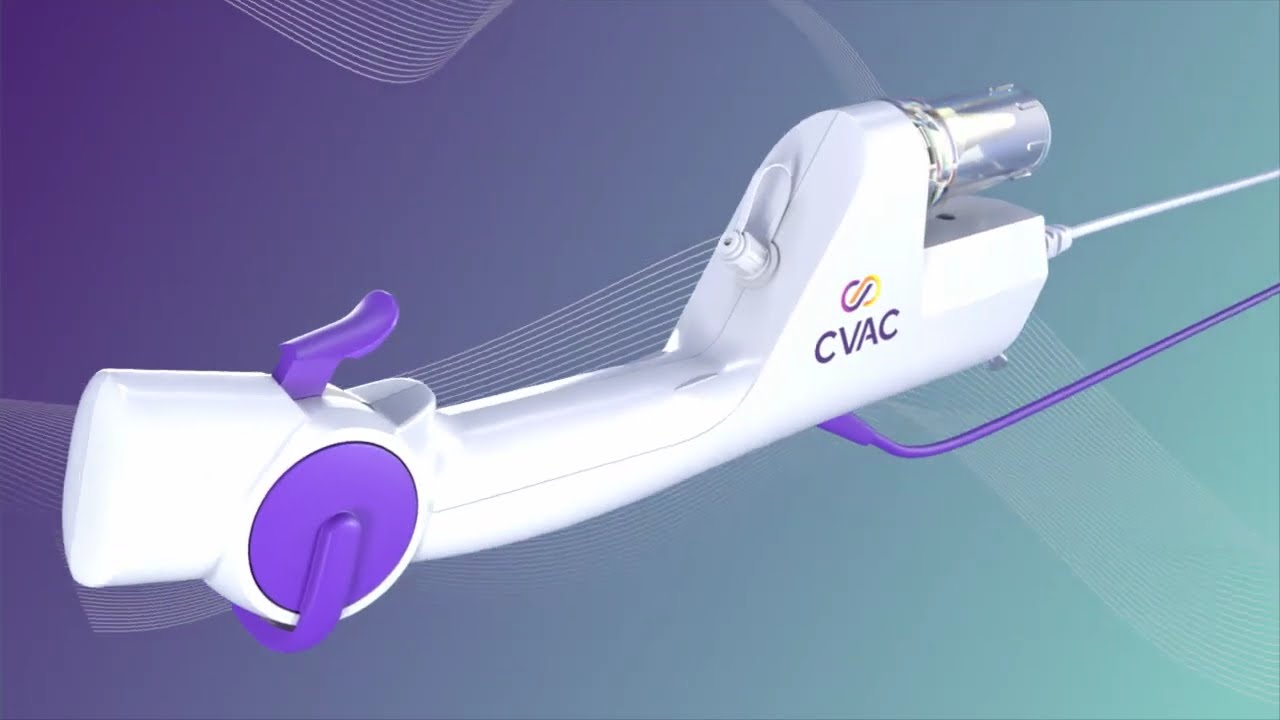 CVAC Kidney Stone Removal System