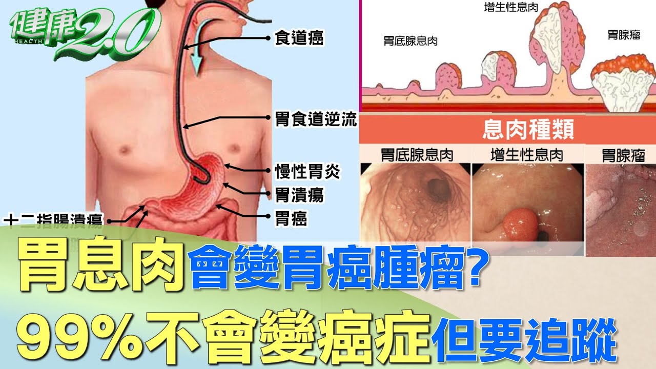 胃息肉會變胃癌腫瘤?99%不會變癌症但要追蹤 健康2.0