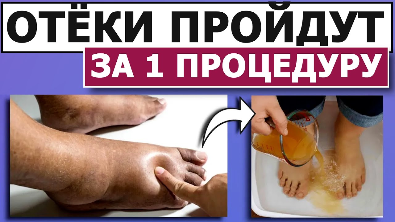 УБЕРИ ОТЁКИ ЗА 1 СЕАНС НАВСЕГДА