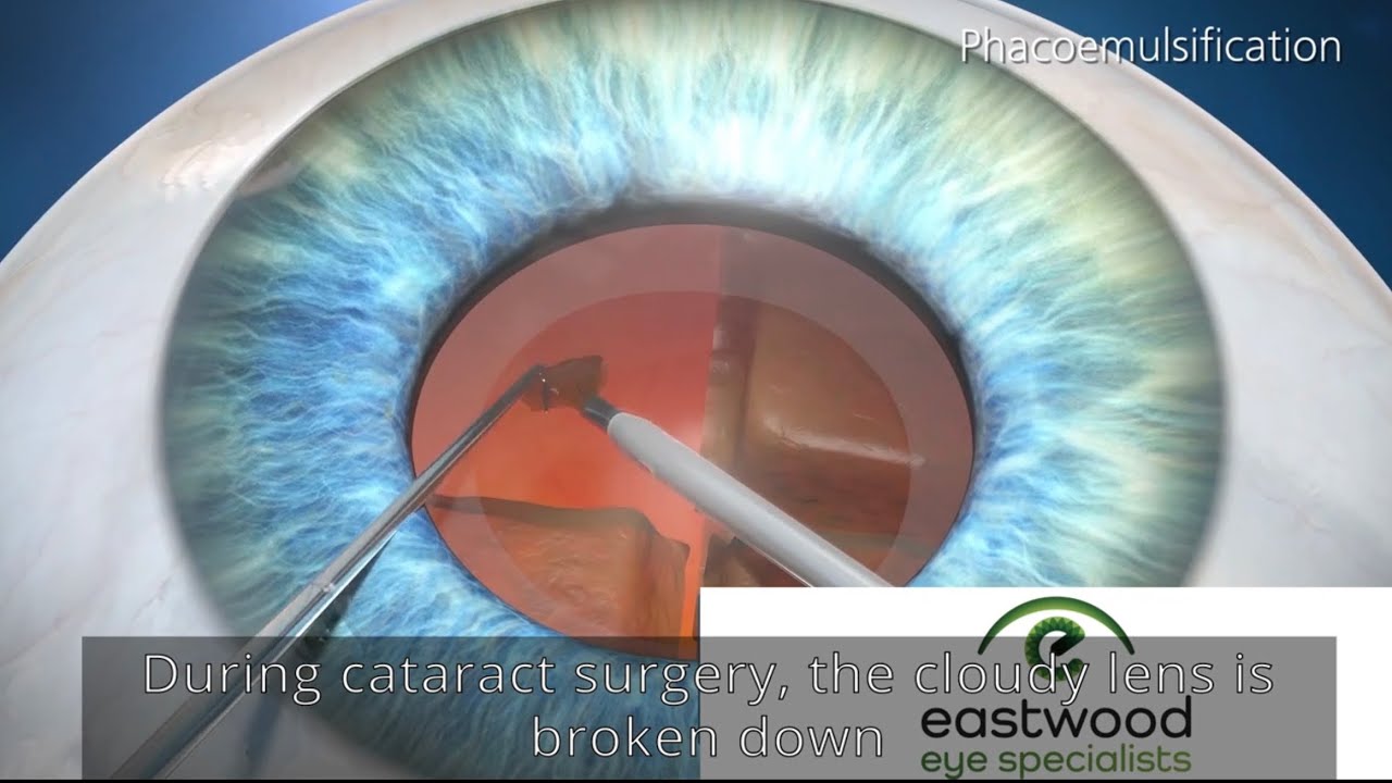 What is involved with Cataract Surgery? Explained by Sydney eye surgeon