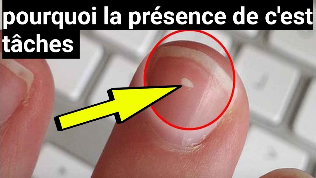 &eacute;nigmes; cette croyance sur l'origine des t&acirc;che sur les ongles est'elle vrai ?🤔