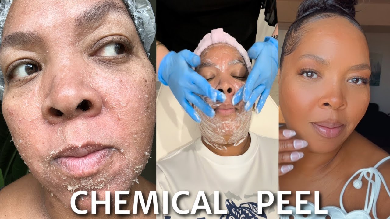 Как проходит химический пилинг от шрамов от акне | Процедура Perfect Derma Peel