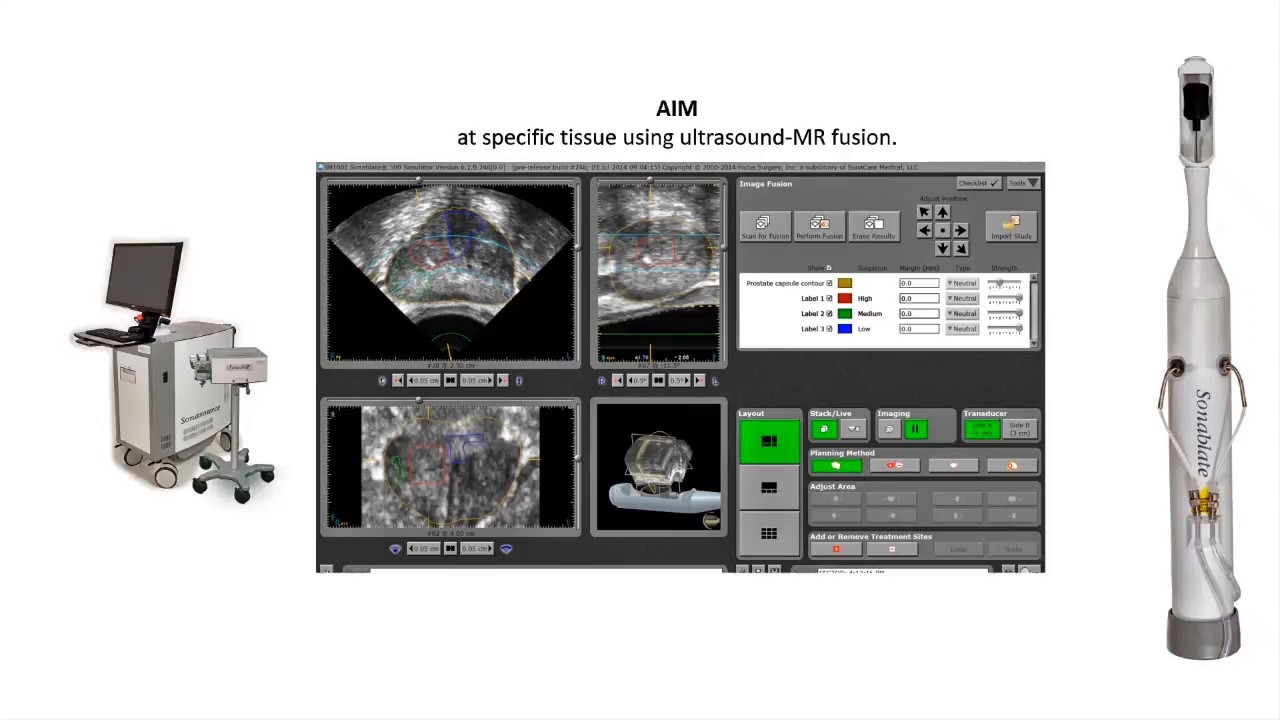 HIFU A New Non Disruptive Method For Curative Management of Prostate Cancer 051018 HIFU918