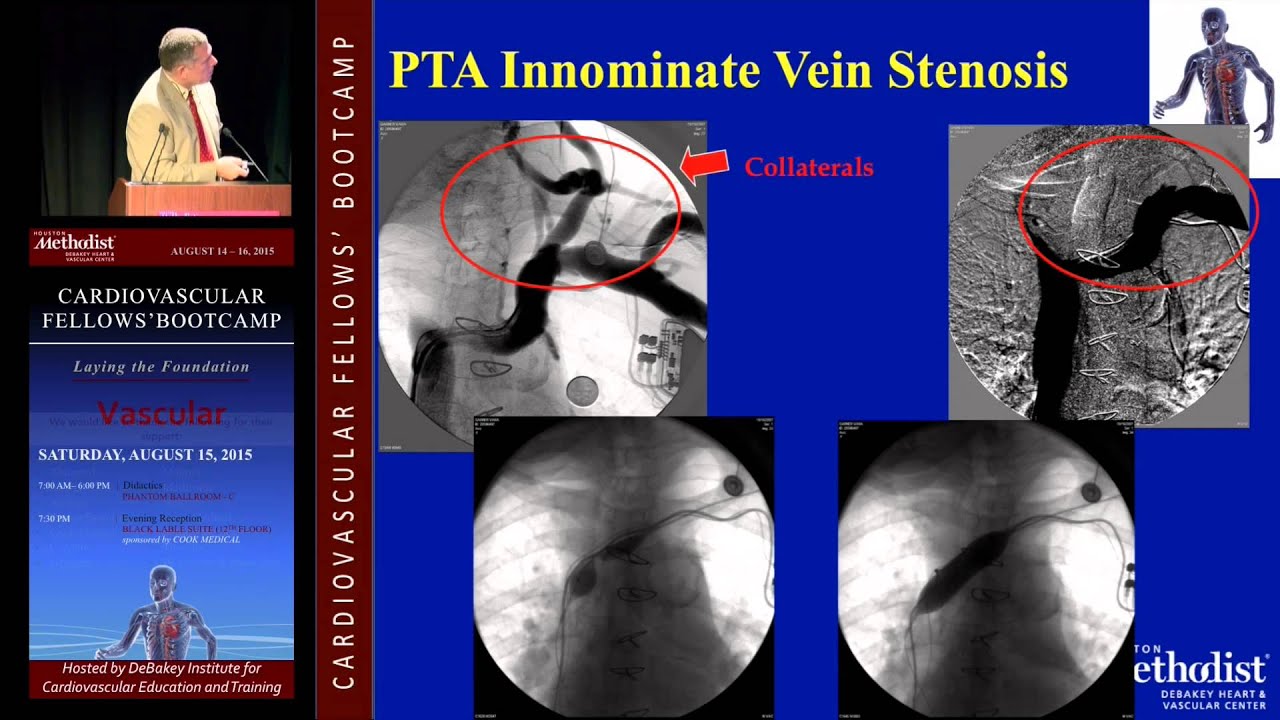 Management and Access Stenosis and Occlusion (Mark Mattos, MD)