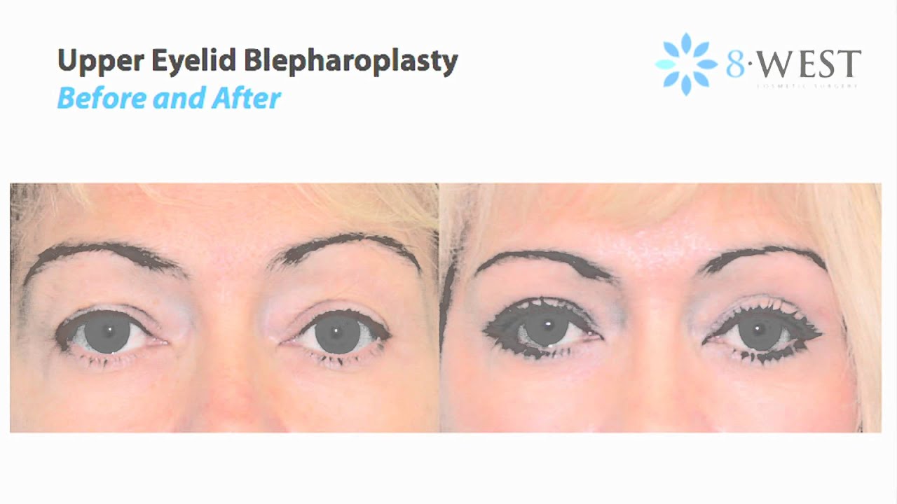 How Upper Eyelid Blepharoplasty Surgery is Performed | Dr. Thomas Buonassisi, 8 West Clinic in BC