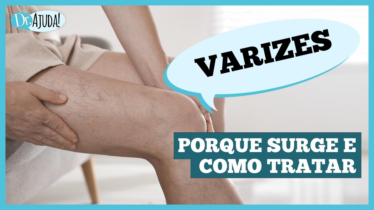 O que são VARIZES e como eliminar?