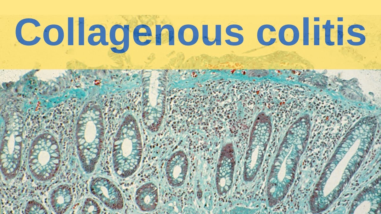 Collagenous Colitis - Pathology mini tutorial