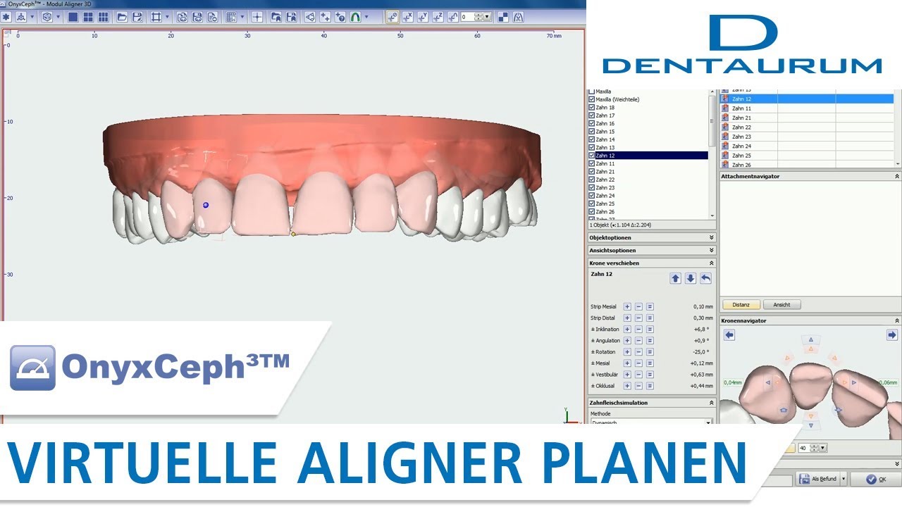 Modul Aligner 3D: Virtuelle Aligner Planung in OnyxCeph3TM