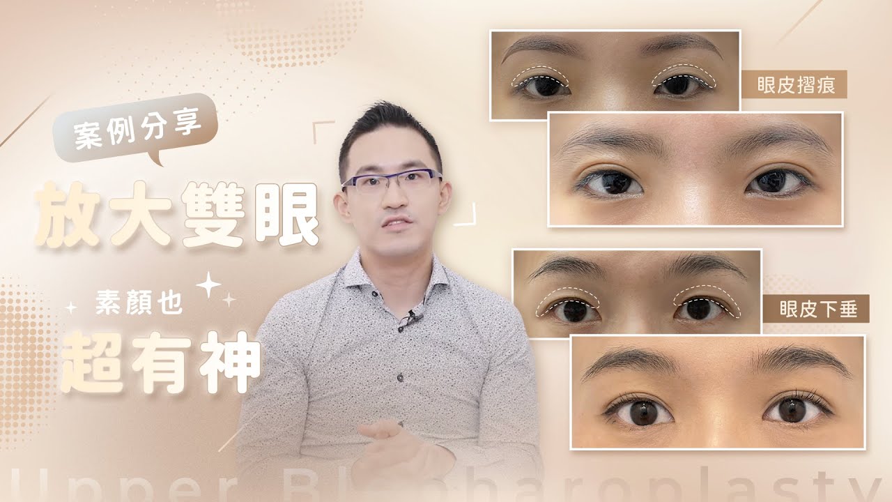 【瞬間放大雙眼！素顏也超有神！】 張容輔醫師＿蒔現美醫美診所