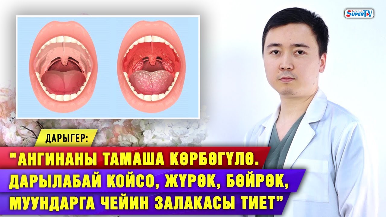 “Ангина жылына 7 жолу кармаса, алдыруу керек” дейт дарыгер