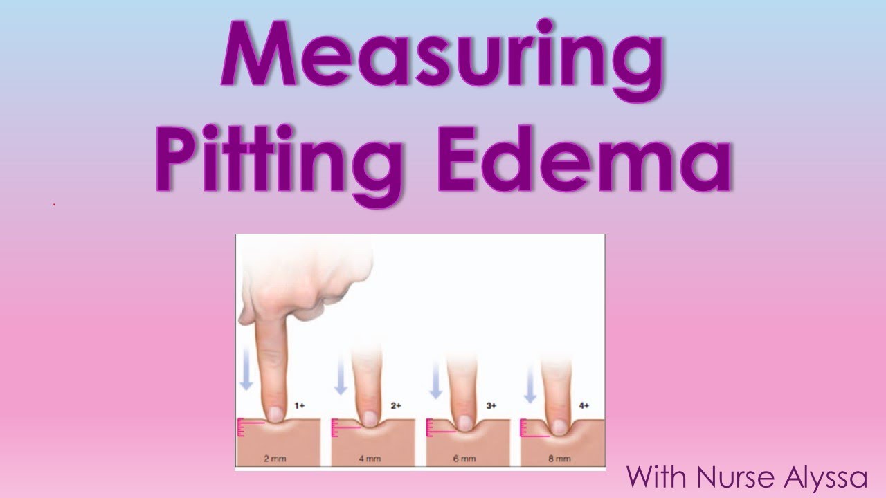 How to measure Pitting Edema