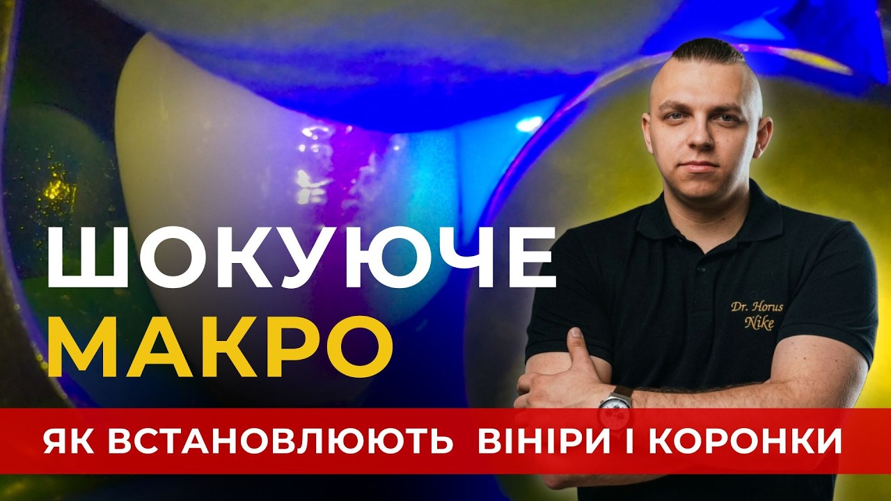 ВРАЖАЮЧЕ МАКРО: Як встановлюють вініри під мікроскопом | Стоматологія Вінниця