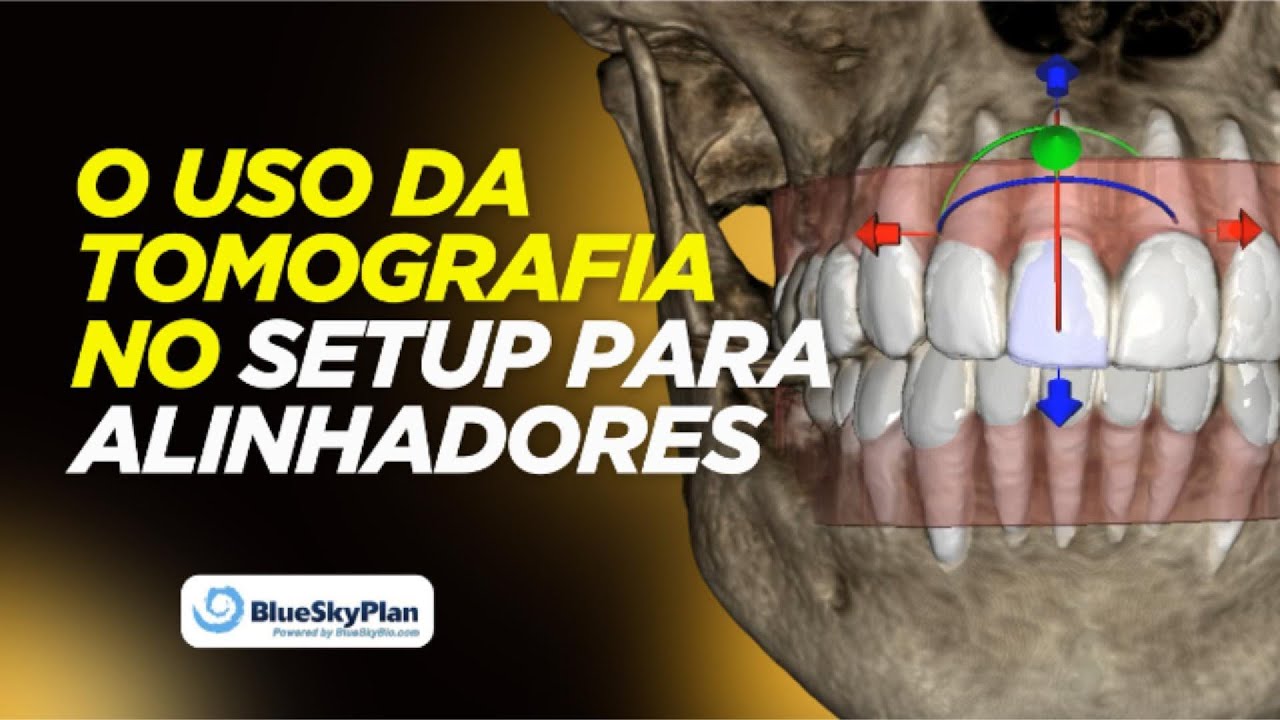Como Usar a Tomografia no Setup de Alinhadores Ortodônticos