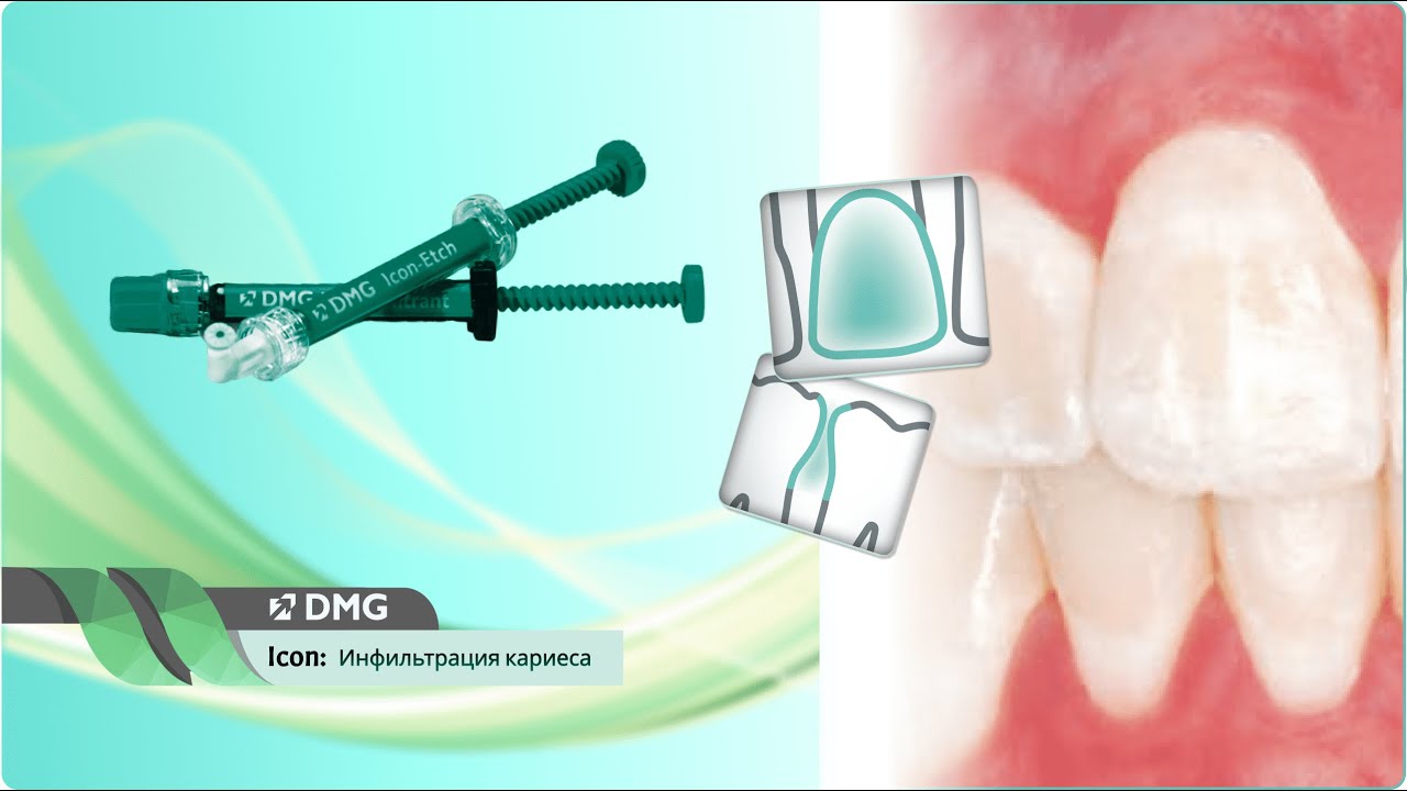 Icon Caries Infiltrant - Один метод - масса возможностей