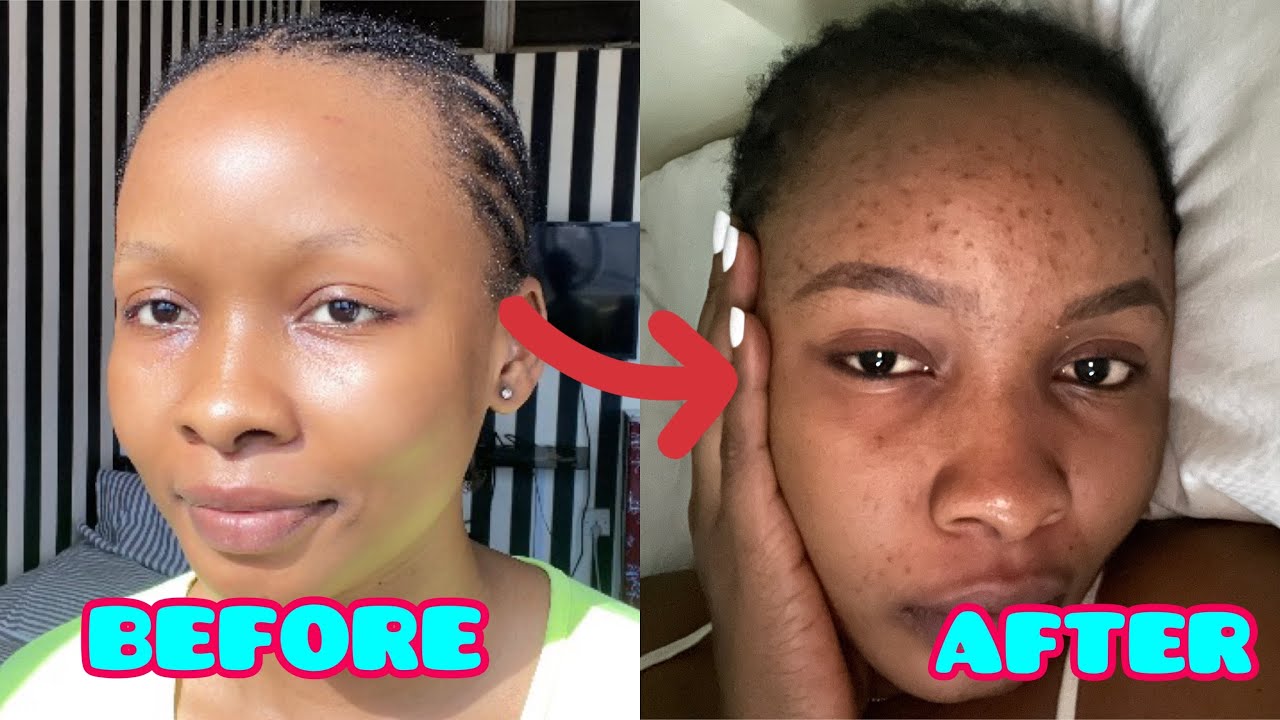 HOW I RUINED MY FACE FOREVER!!! | Dudu  Osun Review